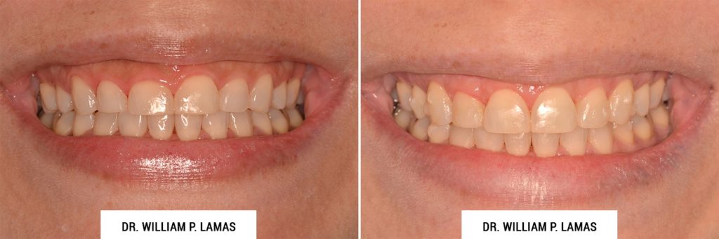Crown Lengthening Before & After Photo - William P. Lamas, DMD - Periodontics & Dental Implants. Address: 2645 SW 37th Ave Suite 304, Miami, FL 33133 Phone: (305) 440-4114