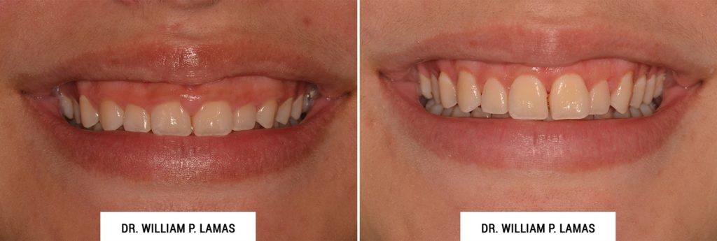Crown Lengthening Before & After Photo - William P. Lamas, DMD - Periodontics & Dental Implants. Address: 2645 SW 37th Ave Suite 304, Miami, FL 33133 Phone: (305) 440-4114