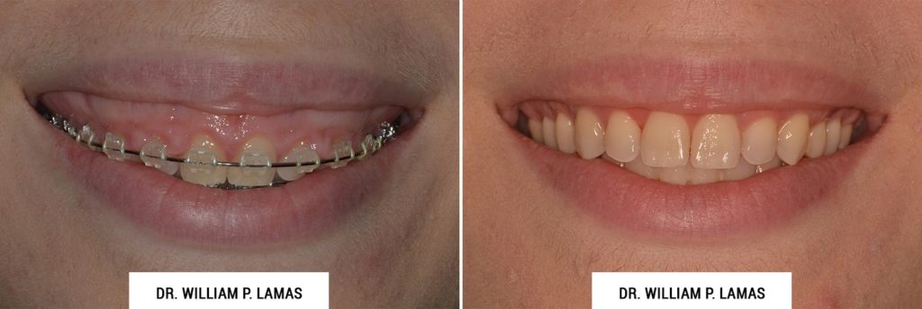 Crown Lengthening Before & After Photo - William P. Lamas, DMD - Periodontics & Dental Implants. Address: 2645 SW 37th Ave Suite 304, Miami, FL 33133 Phone: (305) 440-4114