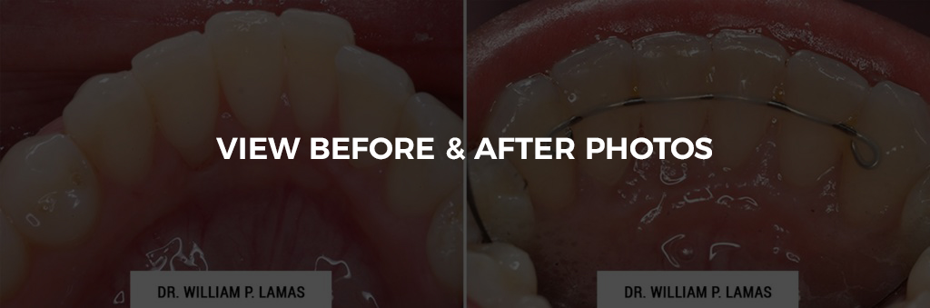 Periodontal Plastic Surgery Before & After Photo - William P. Lamas, DMD - Periodontics & Dental Implants. Address: 2645 SW 37th Ave Suite 304, Miami, FL 33133 Phone: (305) 440-4114