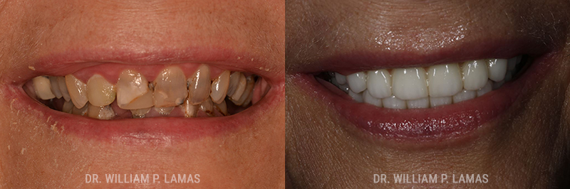 Full Teeth Replacement Before & After Photo - William P. Lamas, DMD - Periodontics & Dental Implants.