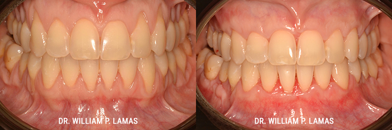 Gum Grafting Treatment Before & After Photo - William P. Lamas, DMD - Periodontics & Dental Implants.