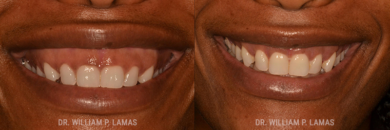 Gummy Smile Correction Before & After Photo - William P. Lamas, DMD - Periodontics & Dental Implants.