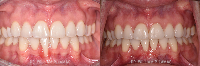 Gum Grafting Treatment Before & After Photo - William P. Lamas, DMD - Periodontics & Dental Implants