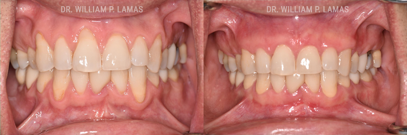 Pinhole Surgical Technique Before & After Photos - William P. Lamas, DMD - Periodontics & Dental Implants.