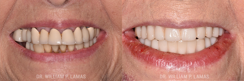 All-on-4 Dental Implants Before & After Photo - William P. Lamas, DMD - Periodontics & Dental Implants.