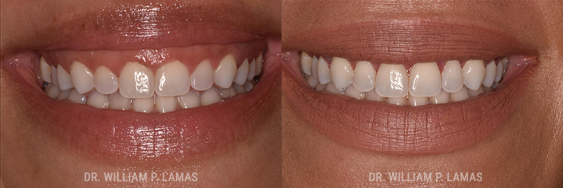 Periodontal Plastic Surgery Before & After Photo - William P. Lamas, DMD - Periodontics & Dental Implants.