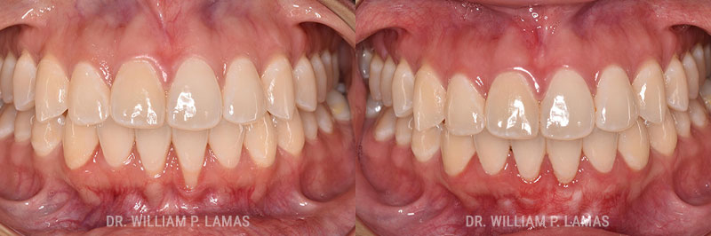 Gum Grafting Treatment Before & After Photo - William P. Lamas, DMD - Periodontics & Dental Implants