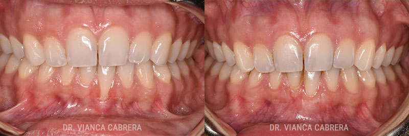 Gum Grafting Treatment Before & After Photo - Dr. Vianca Cabrera