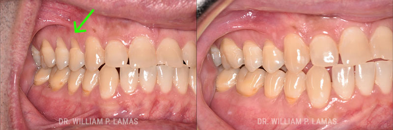 Gum Grafting Treatment Before & After Photo - William P. Lamas, DMD - Periodontics & Dental Implants